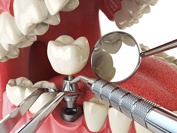 Best Emergency Tooth Extraction in Murphy, TX